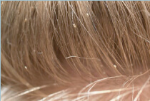 lice-pics-1