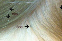 lice-pics-2